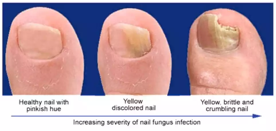 How to Treat Nail Fungus Infections: See Results In 01 Week