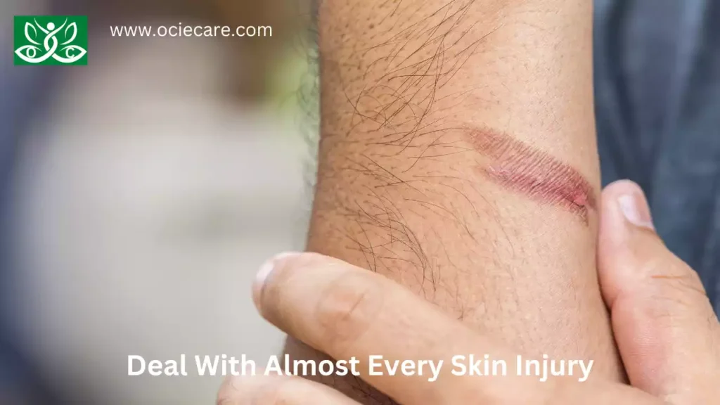 Deal With Almost Every Skin Injury