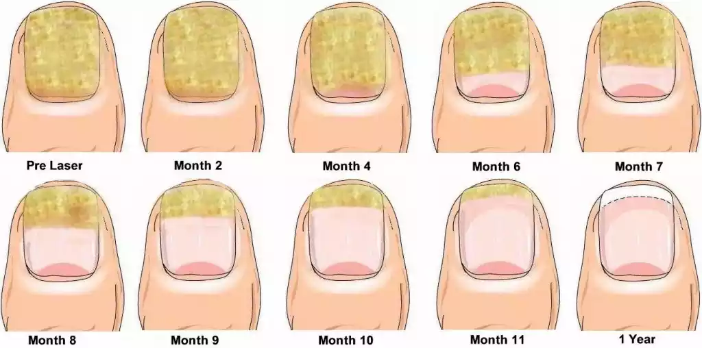 How to Treat Nail Fungus Infections: See Results In 01 Week