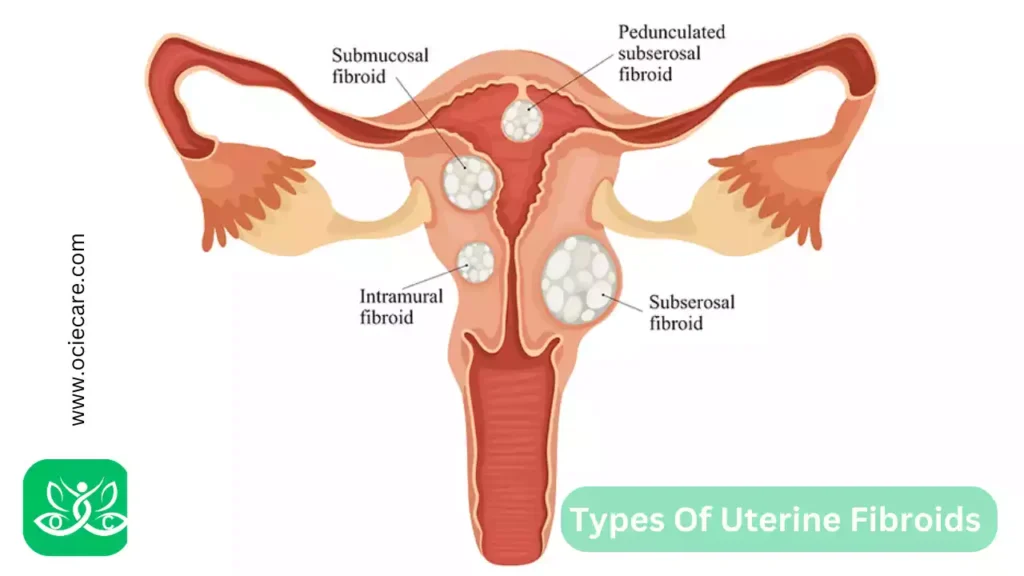 Types Of Uterine Fibroids 