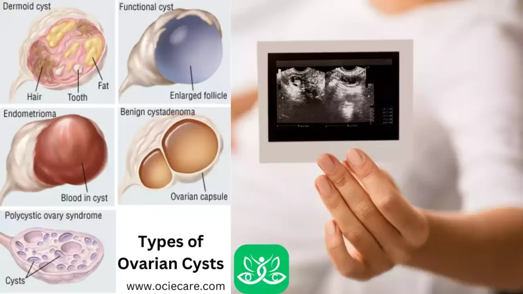 Types of Ovarian Cysts