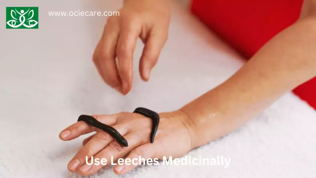 Use Leeches Medicinally