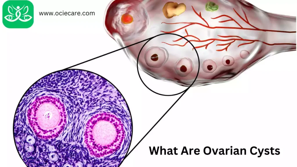 What Are Ovarian Cysts