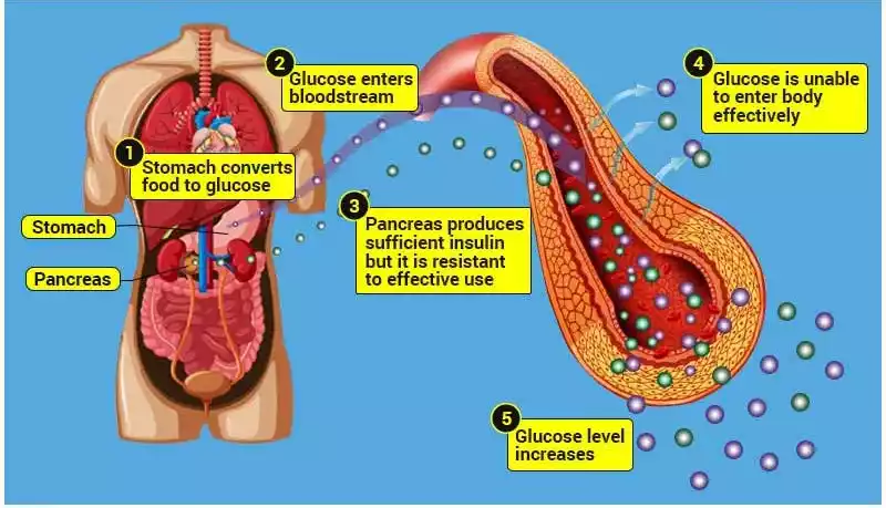 Blood Sugar | Diabetes: Understanding, Treatment, and Prevention In 2023