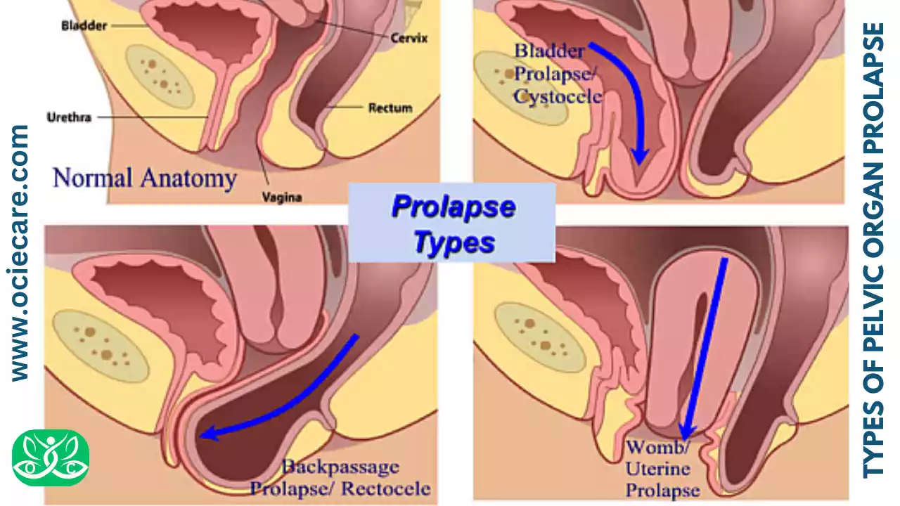 Pelvic Organ Prolapse: Natural Treatment Without Medicine In 2023