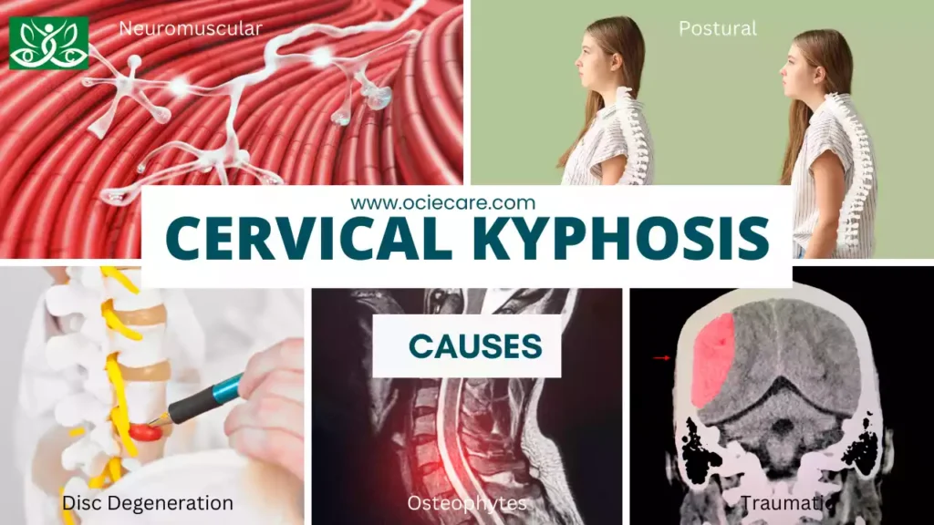 Cervical Kyphosis Causes