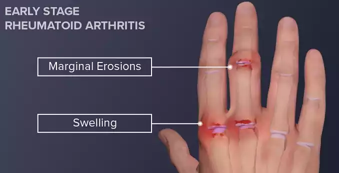 RA-early-stage-fingers